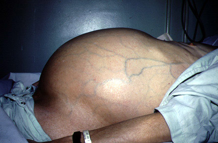 xơ gan cổ trướng